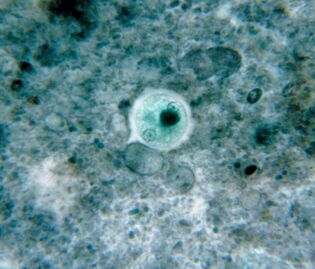 Disenteria ameba