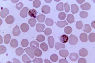 Malaria plasmodioa